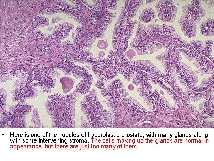  • Here is one of the nodules of hyperplastic prostate, with many glands
