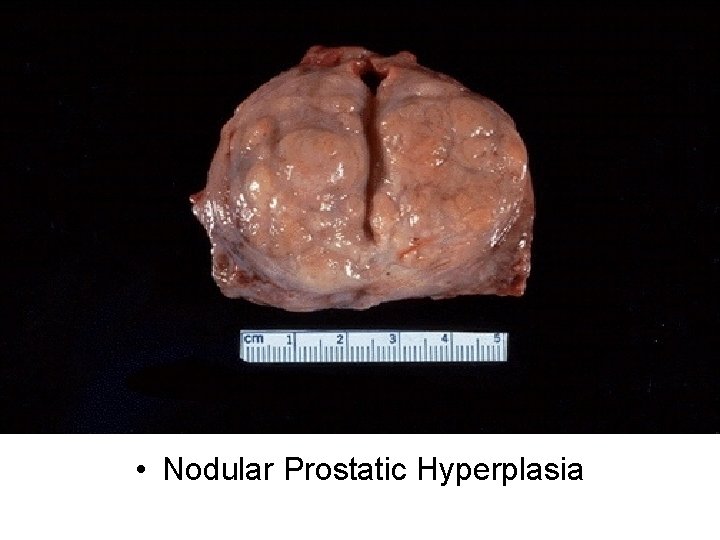  • Nodular Prostatic Hyperplasia 