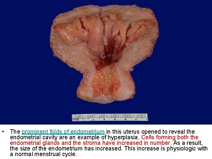  • The prominent folds of endometrium in this uterus opened to reveal the