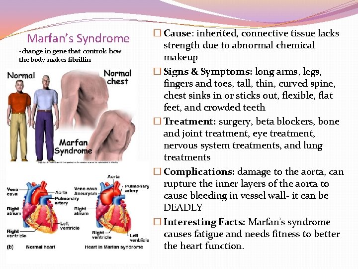 Marfan’s Syndrome -change in gene that controls how the body makes fibrillin � Cause: Marfan’s Syndrome -change in gene that controls how the body makes fibrillin � Cause: