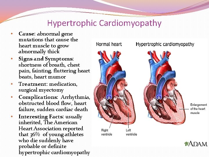 Hypertrophic Cardiomyopathy • • • Cause: abnormal gene mutations that cause the heart muscle Hypertrophic Cardiomyopathy • • • Cause: abnormal gene mutations that cause the heart muscle