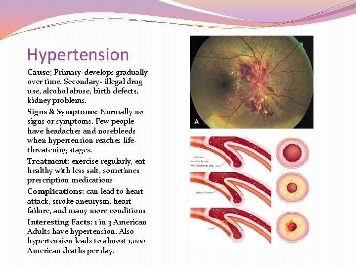 Hypertension Cause; Primary-develops gradually over time. Secondary- illegal drug use, alcohol abuse, birth defects, Hypertension Cause; Primary-develops gradually over time. Secondary- illegal drug use, alcohol abuse, birth defects,