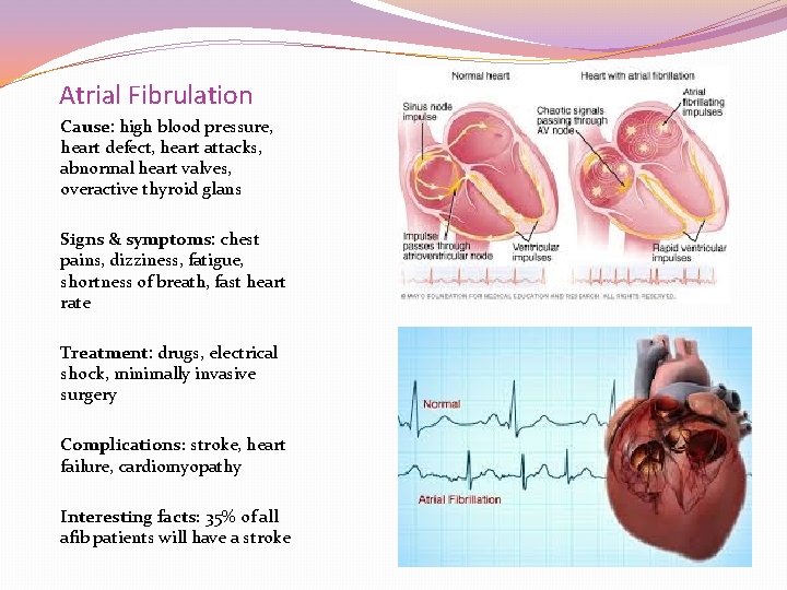 Atrial Fibrulation Cause: high blood pressure, heart defect, heart attacks, abnormal heart valves, overactive Atrial Fibrulation Cause: high blood pressure, heart defect, heart attacks, abnormal heart valves, overactive