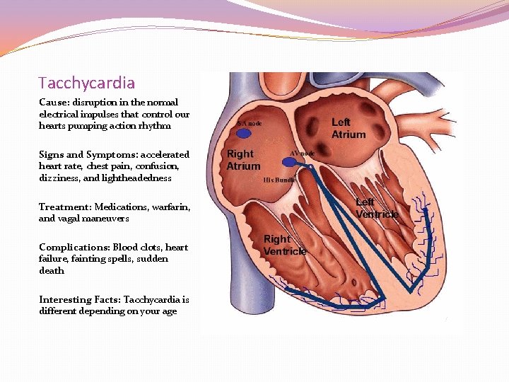 Tacchycardia Cause: disruption in the normal electrical impulses that control our hearts pumping action Tacchycardia Cause: disruption in the normal electrical impulses that control our hearts pumping action