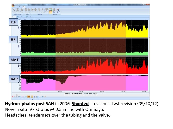 ICP HR AMP RAP Hydrocephalus post SAH in 2006. Shunted - revisions. Last revision