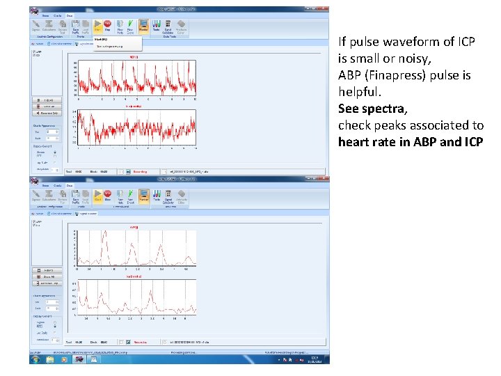 If pulse waveform of ICP is small or noisy, ABP (Finapress) pulse is helpful.