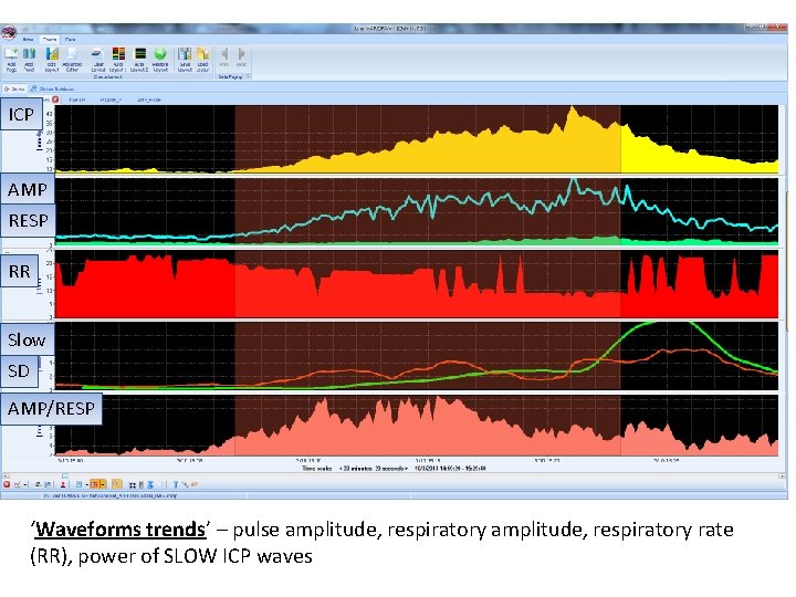 ICP AMP RESP RR Slow SD AMP/RESP ‘Waveforms trends’ – pulse amplitude, respiratory rate