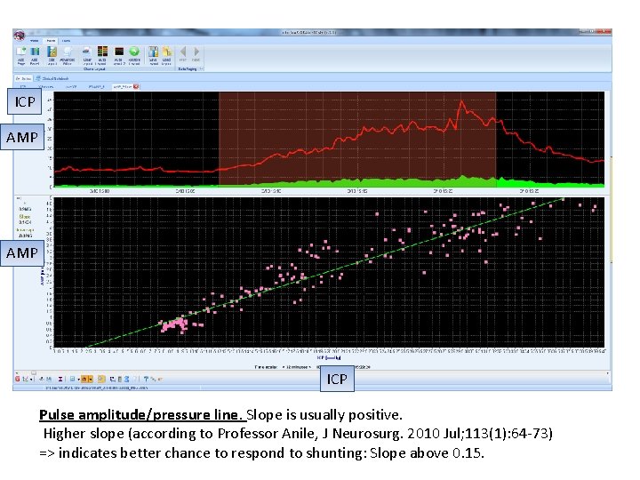 ICP AMP ICP Pulse amplitude/pressure line. Slope is usually positive. Higher slope (according to