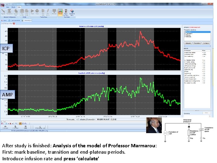 ICP AMP After study is finished: Analysis of the model of Professor Marmarou: First: