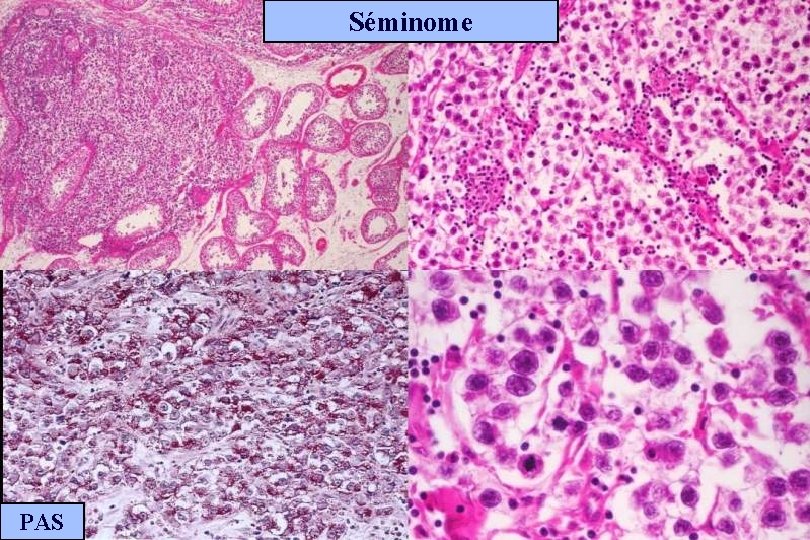 Séminome PAS 
