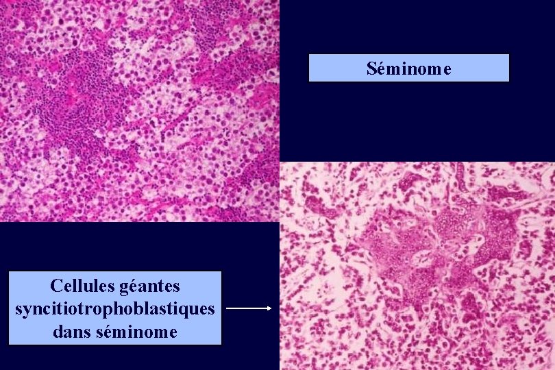 Séminome Cellules géantes syncitiotrophoblastiques dans séminome 