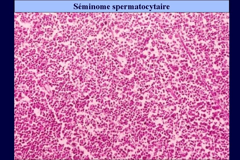 Séminome spermatocytaire 