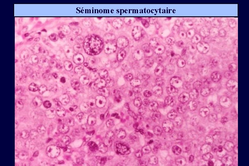 Séminome spermatocytaire 