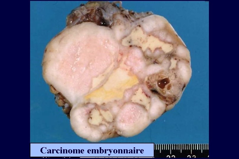 Carcinome embryonnaire 