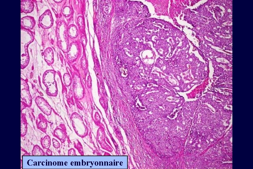 Carcinome embryonnaire 