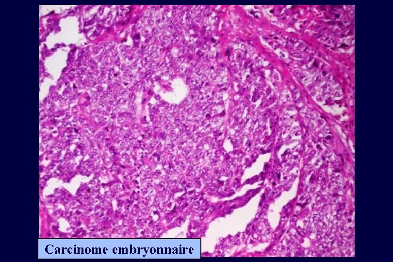 Carcinome embryonnaire 
