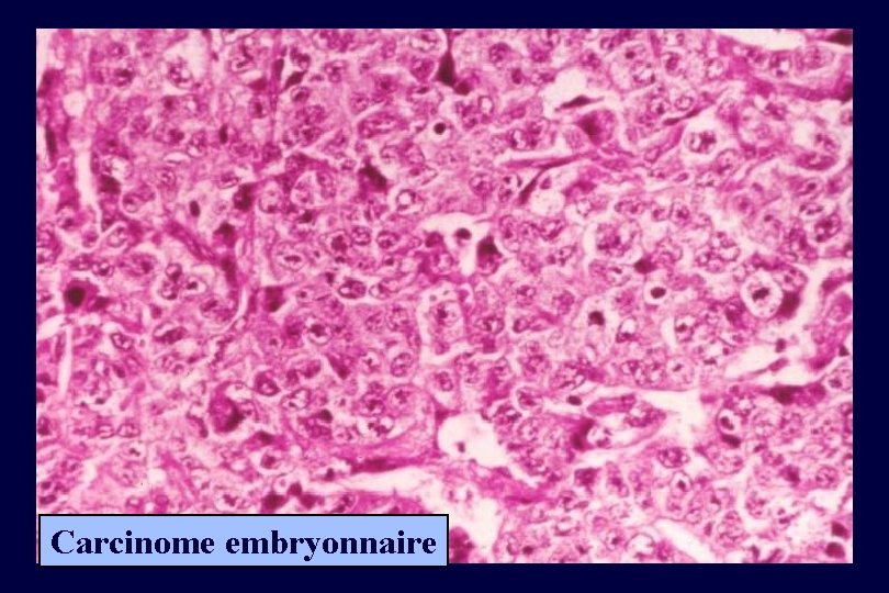 Carcinome embryonnaire 
