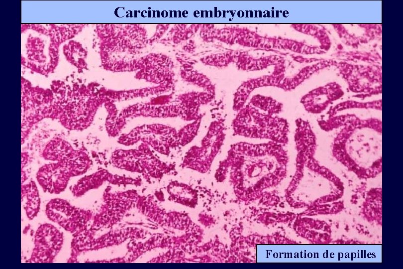 Carcinome embryonnaire Formation de papilles 