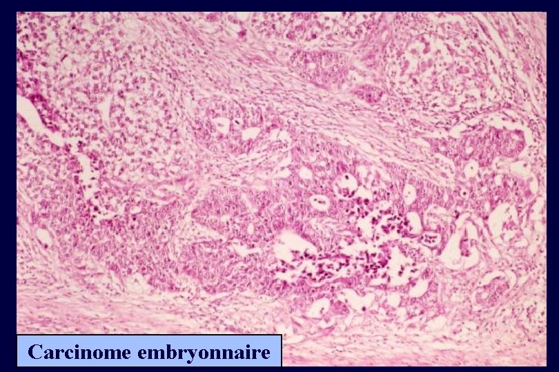 Carcinome embryonnaire 