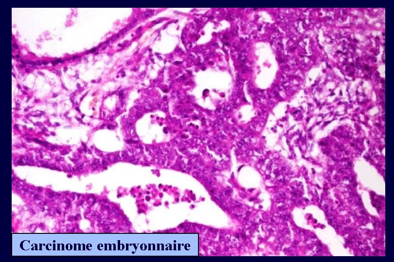 Carcinome embryonnaire 
