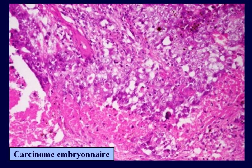 Carcinome embryonnaire 