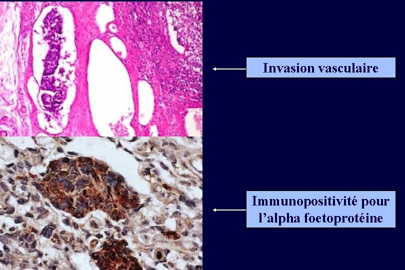 Invasion vasculaire Immunopositivité pour l’alpha foetoprotéine 