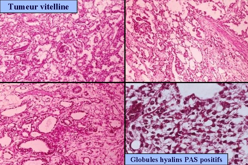 Tumeur vitelline Globules hyalins PAS positifs 