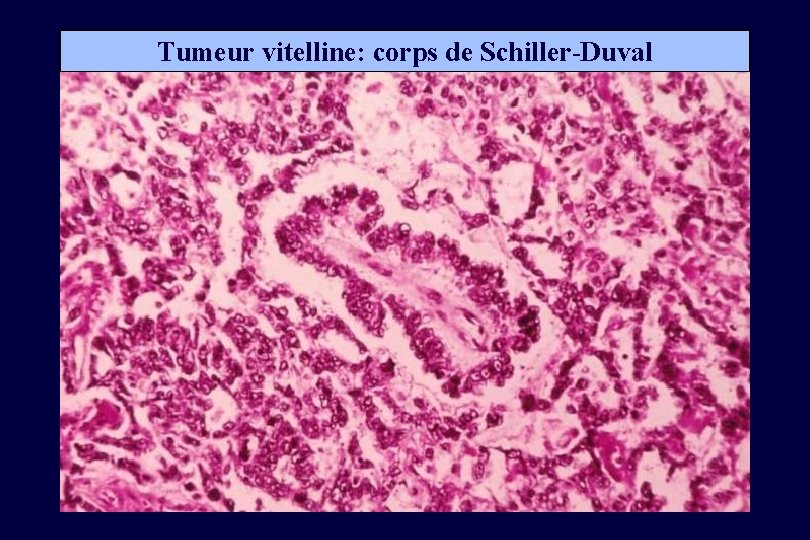 Tumeur vitelline: corps de Schiller-Duval 