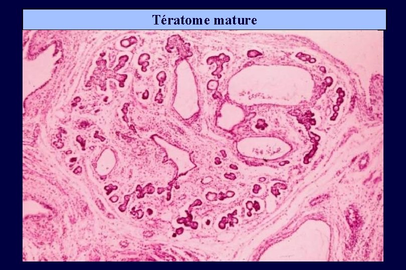 Tératome mature 