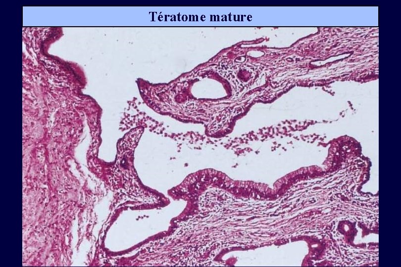 Tératome mature 