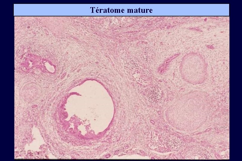 Tératome mature 