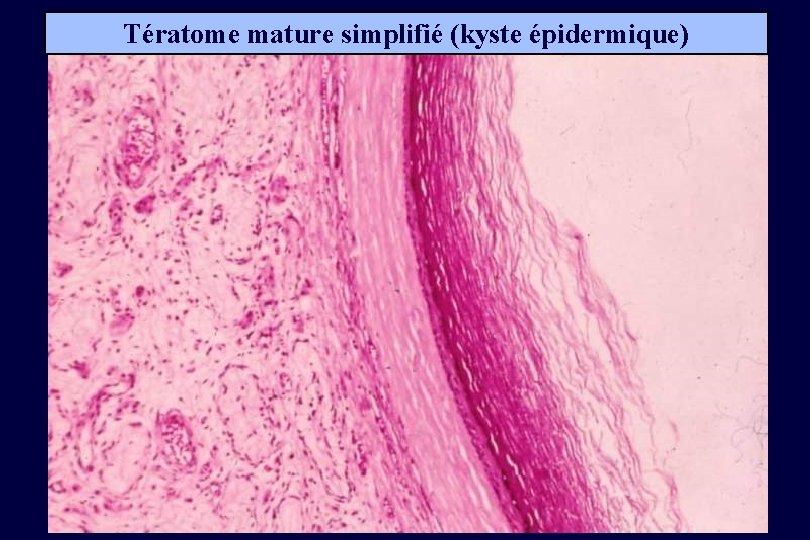 Tératome mature simplifié (kyste épidermique) 