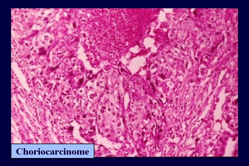 Choriocarcinome 