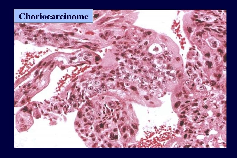 Choriocarcinome 