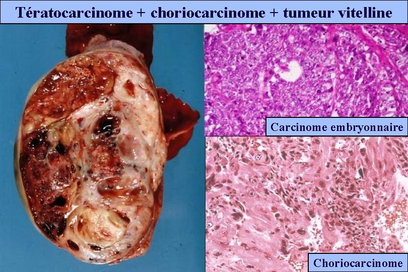 Tératocarcinome + choriocarcinome + tumeur vitelline Carcinome embryonnaire Choriocarcinome 