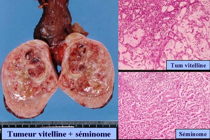 Tum vitelline Tumeur vitelline + séminome Séminome 