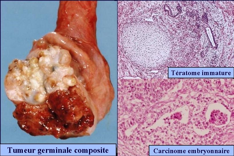 Tératome immature Tumeur germinale composite Carcinome embryonnaire 