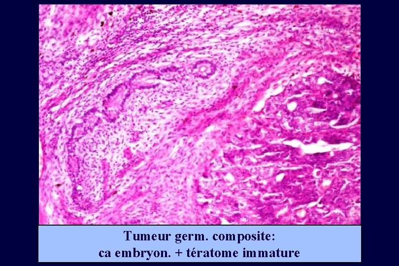 Tumeur germ. composite: ca embryon. + tératome immature 
