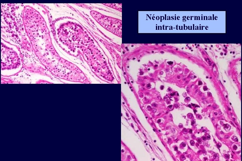 Néoplasie germinale intra-tubulaire 