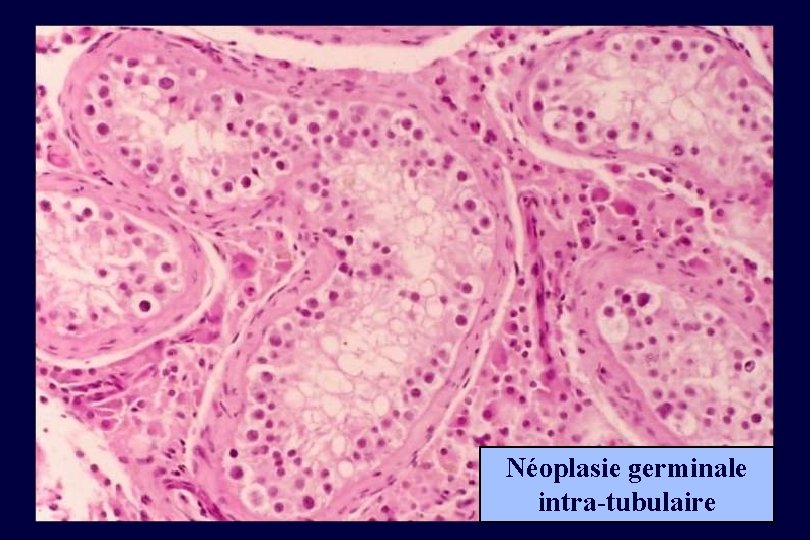 Néoplasie germinale intra-tubulaire 