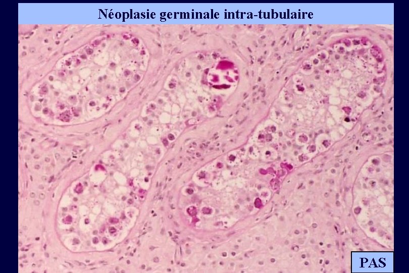 Néoplasie germinale intra-tubulaire PAS 
