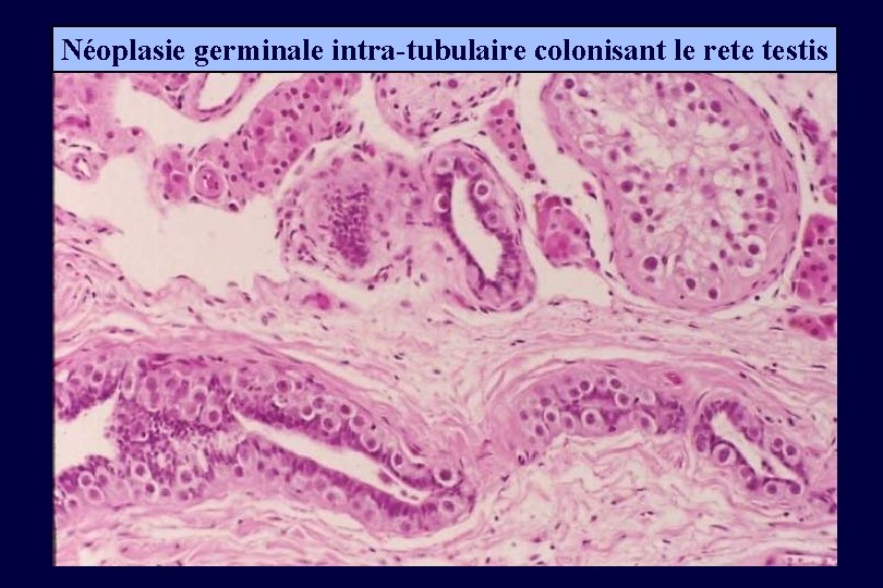 Néoplasie germinale intra-tubulaire colonisant le rete testis 