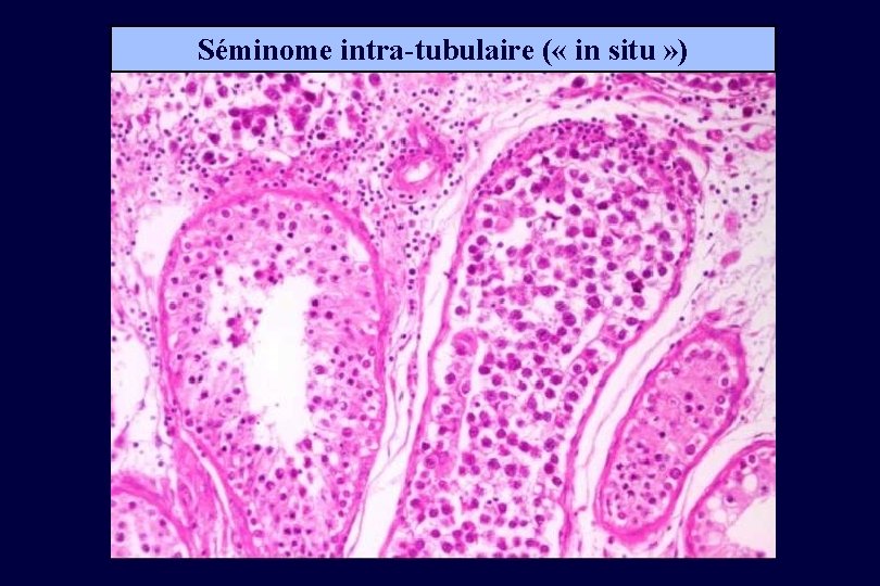 Séminome intra-tubulaire ( « in situ » ) 