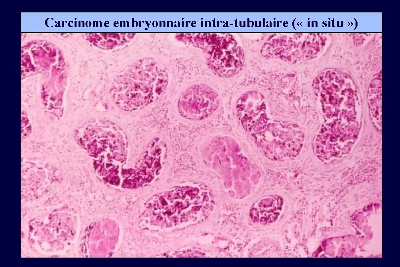 Carcinome embryonnaire intra-tubulaire ( « in situ » ) 