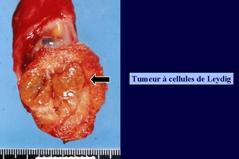 Tumeur à cellules de Leydig 