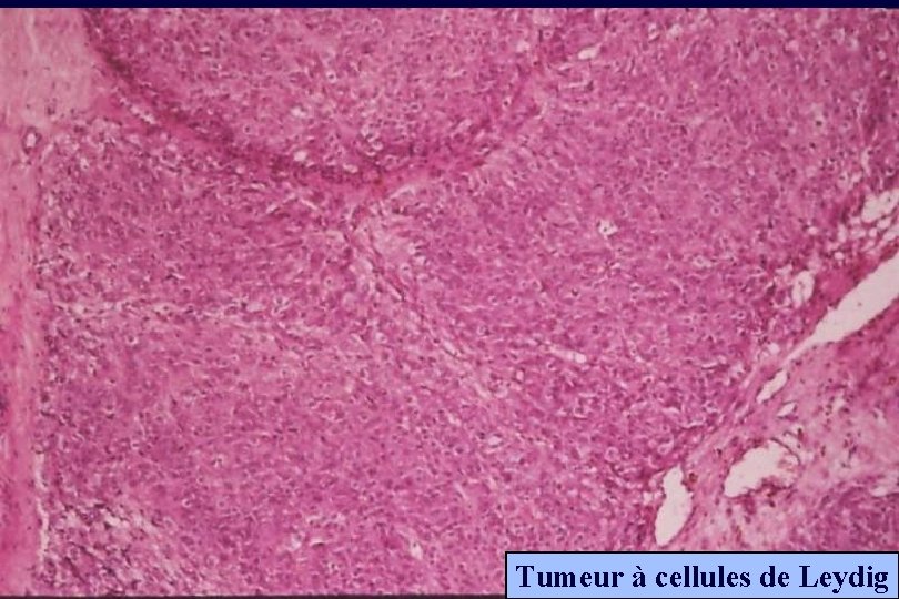 Tumeur à cellules de Leydig 