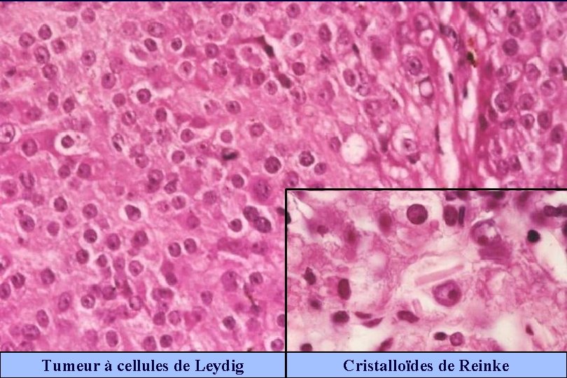 Tumeur à cellules de Leydig Cristalloïdes de Reinke 