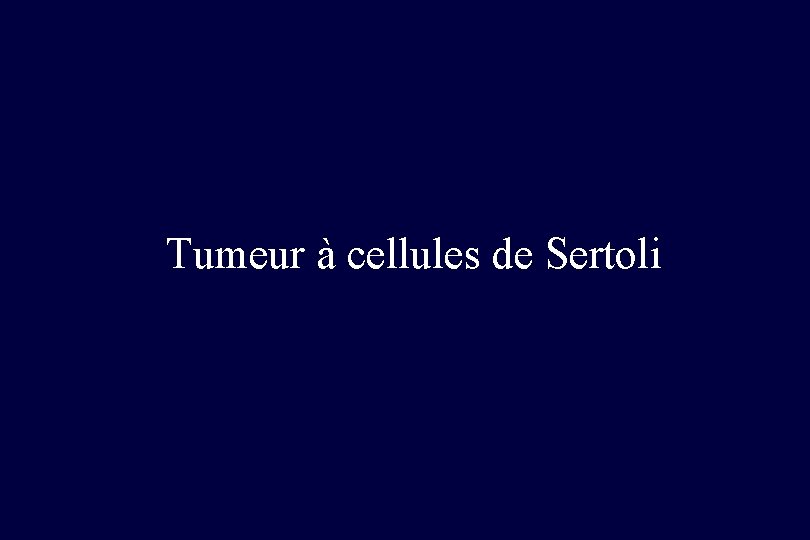 Tumeur à cellules de Sertoli 