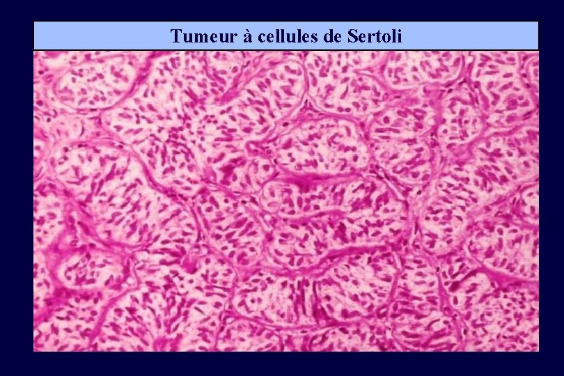 Tumeur à cellules de Sertoli 