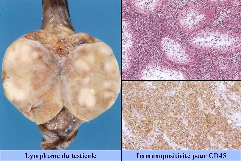 Lymphome du testicule Immunopositivité pour CD 45 